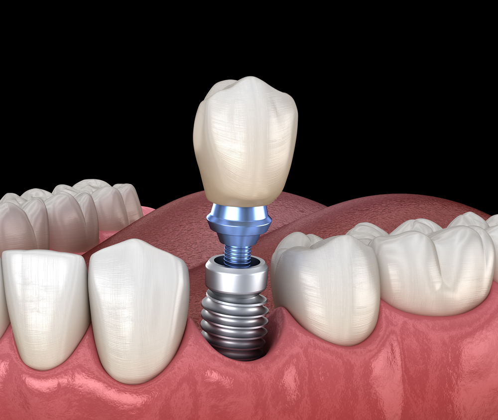 Quais são as opções para a substituição de dentes perdidos? 3 Implantodontia