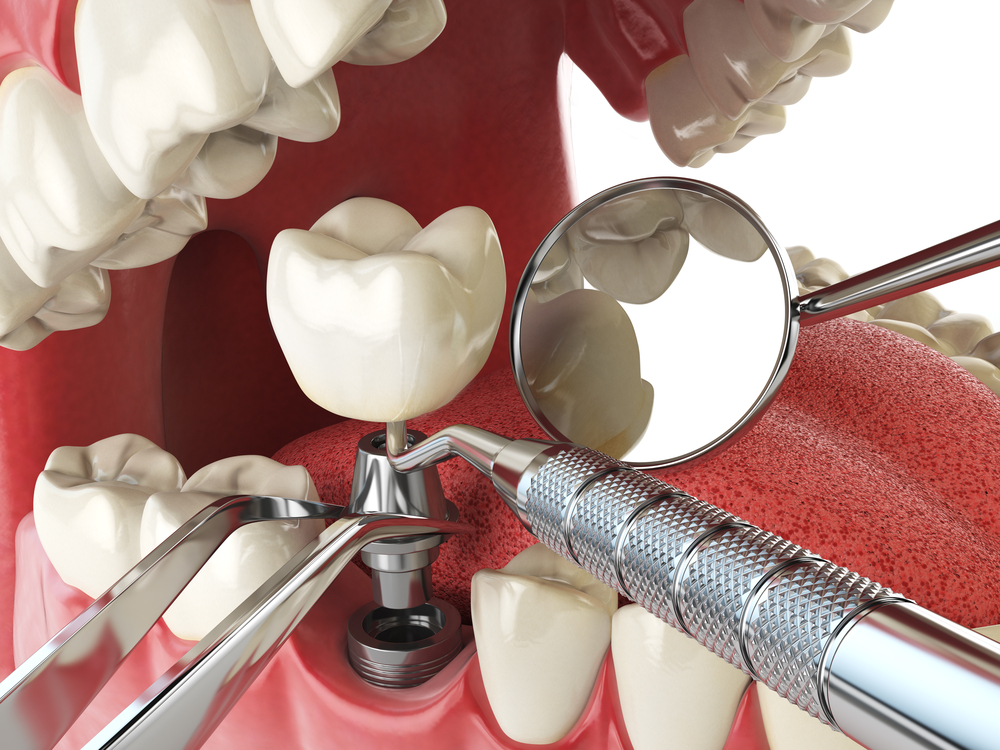 Quais são as opções para a substituição de dentes perdidos? 2 implante